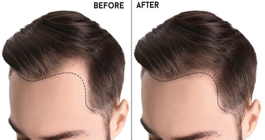 hair-transplant-without-surgery